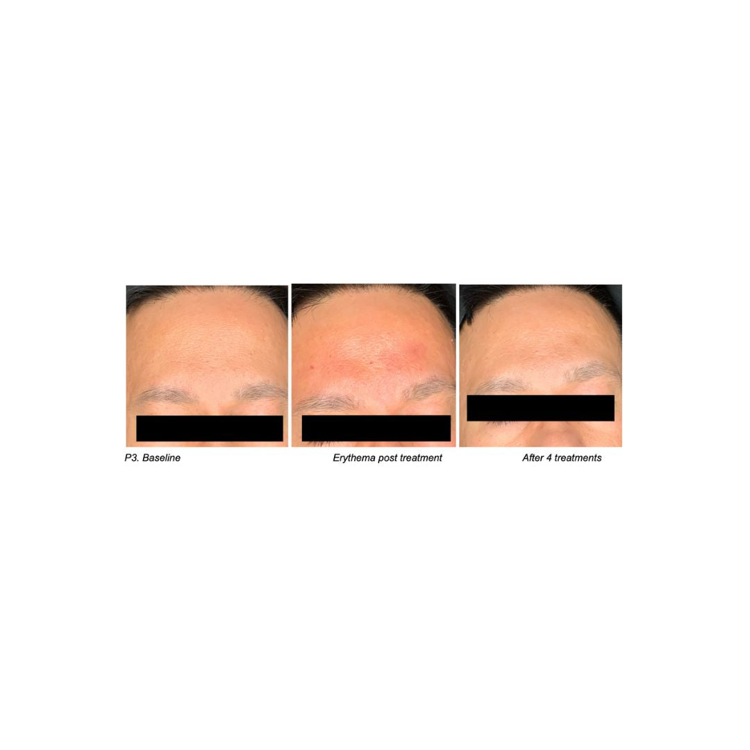 Phytotide CRF Cellular Renewal Factor 5 Ampoules