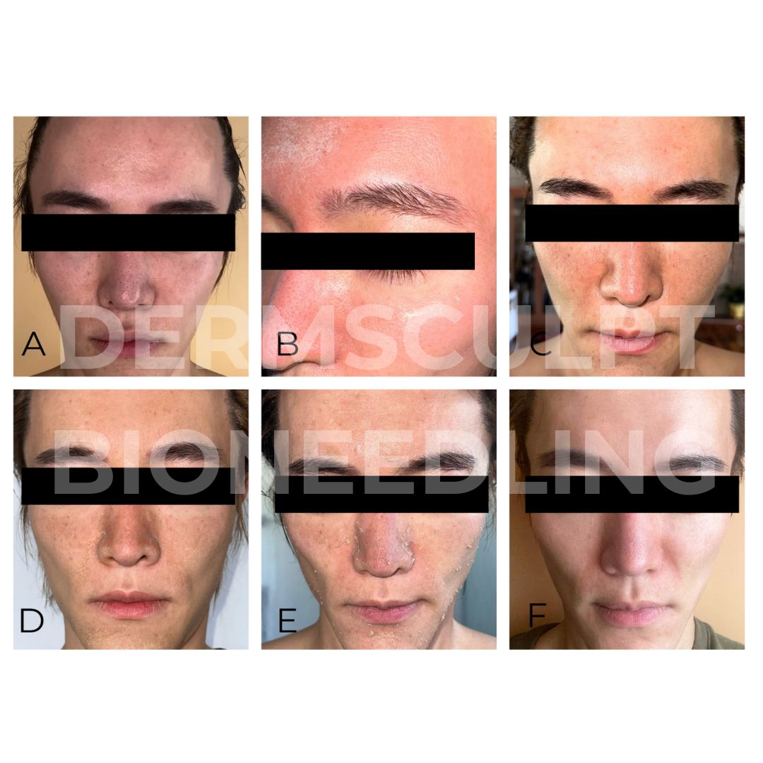 Dermsculpt Bioneedling 1000